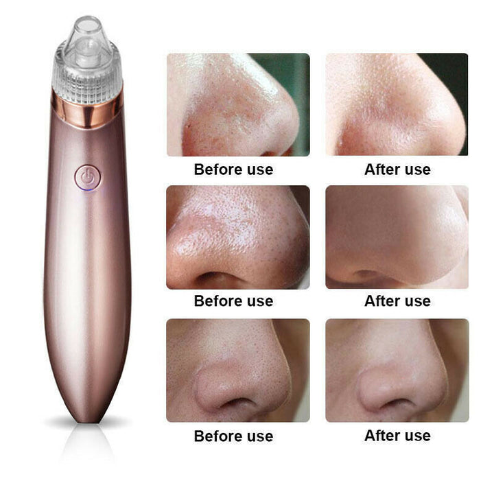 Electric Blackhead Vacuum Pore Cleaner with Strong Suction for Acne Removal